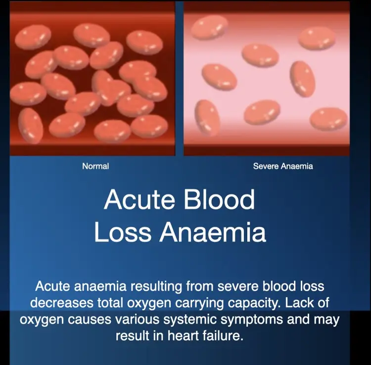 Hiperbariese suurstofterapie for severe blood-loss anaemia