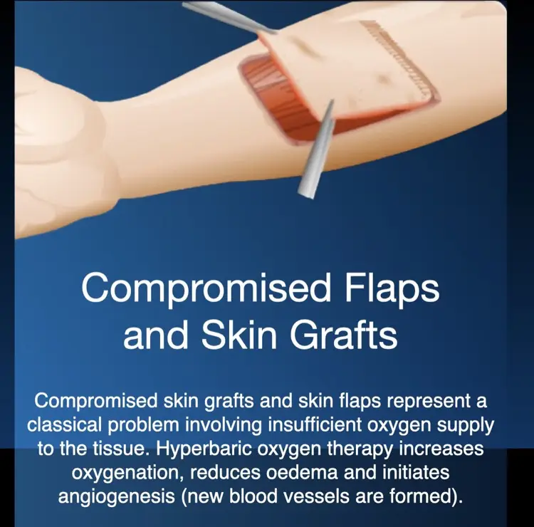 Hiperbariese suurstofterapie for compromised grafts and flaps