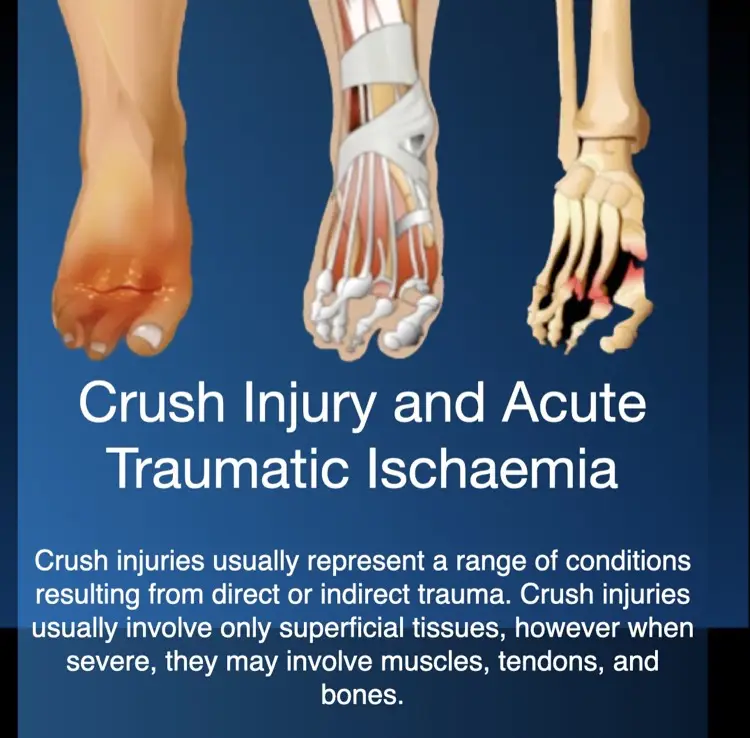 Hiperbariese suurstofterapie for crush injury and acute traumatic ischaemia