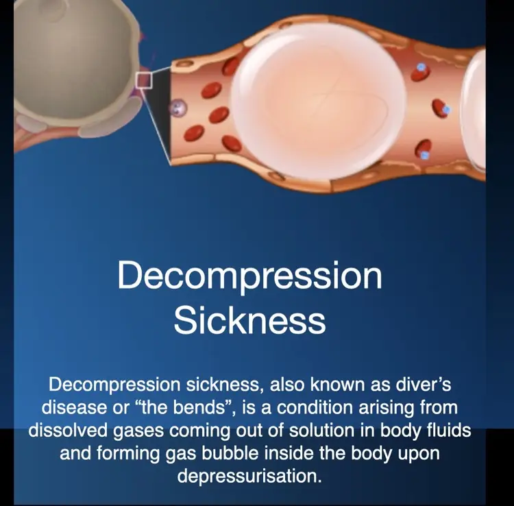 Hiperbariese suurstofterapie for decompression sickness