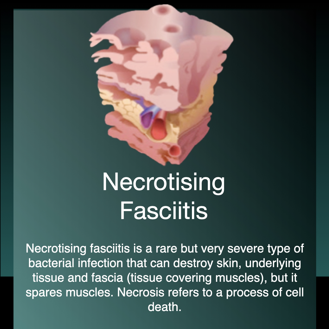 Necrotising Fasciitis