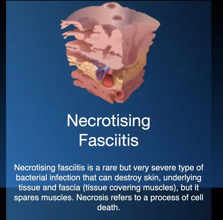 Hyperbaric oxygen therapy for necrotising soft-tissue infections