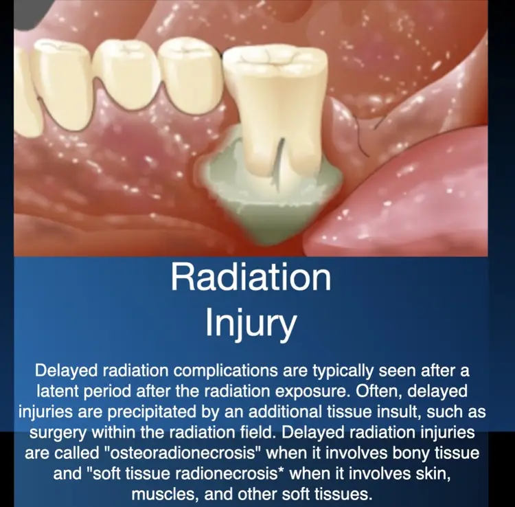 Hiperbariese suurstofterapie for late radiation injury and osteoradionecrosis