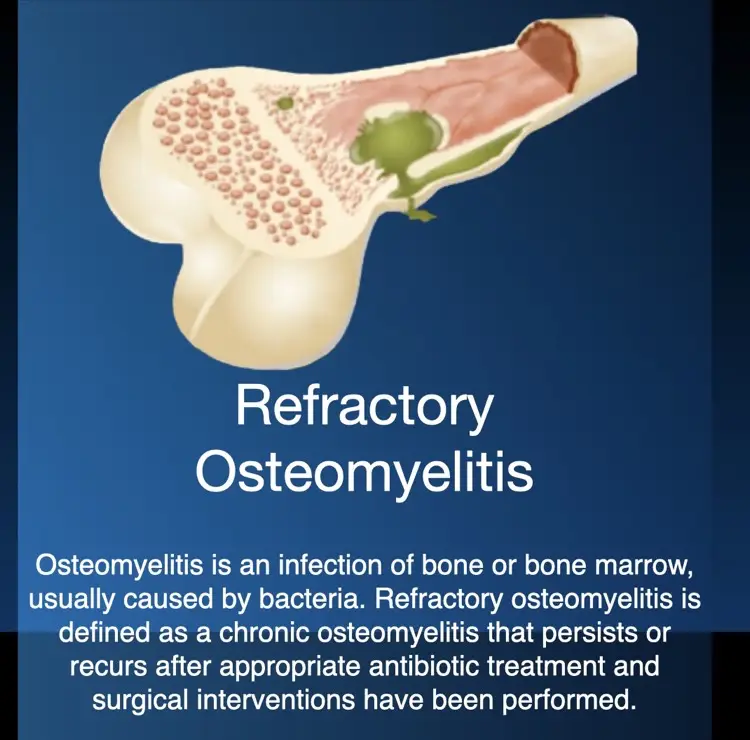 Hiperbariese suurstofterapie for refractory osteomyelitis