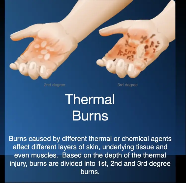 Hiperbariese suurstofterapie for acute thermal burns